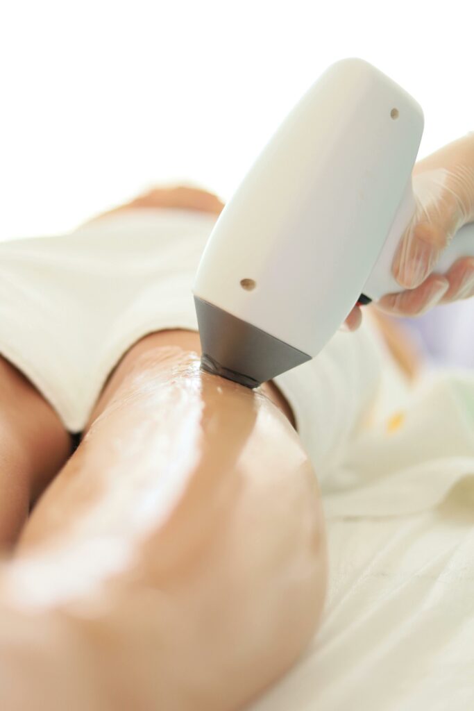 épilation laser Colmar
