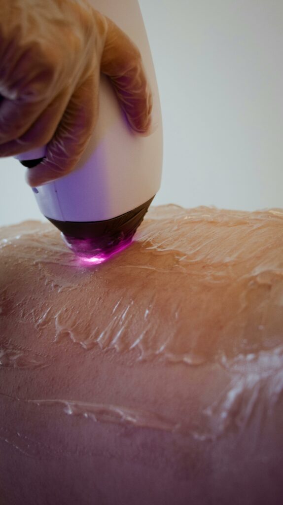 épilation laser Colmar
